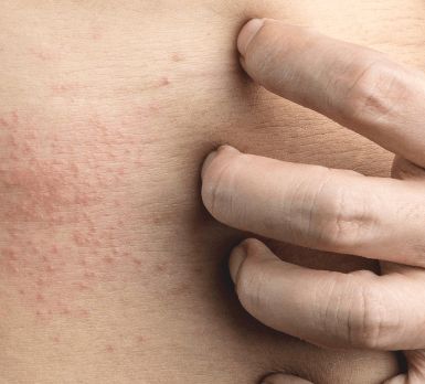 Skin-allergy-treatment-in-homeopathy